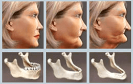 Perdida de hueso implantes dentalles
