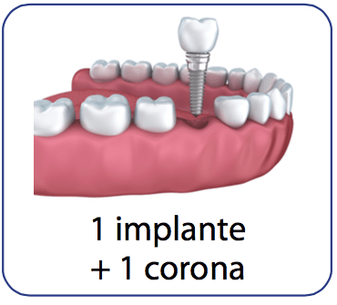 Implante dental y corona